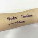 Tondaus skin marker