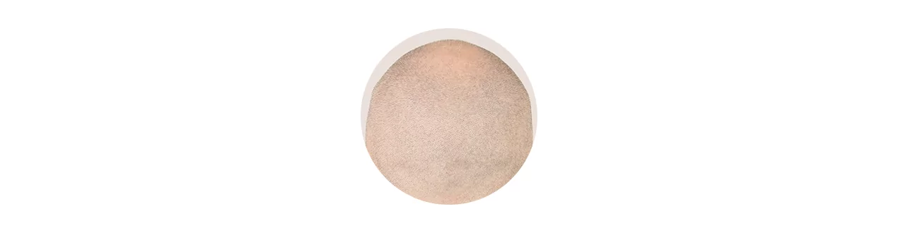 Scalp
